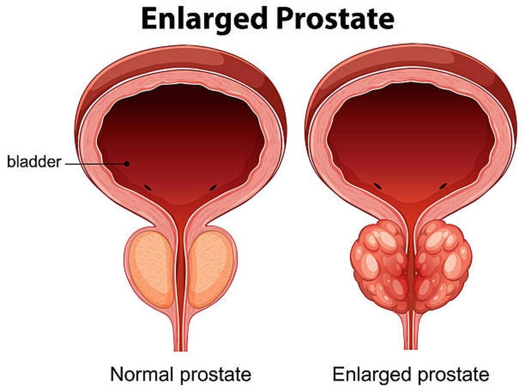 Best Doctor For Enlarged Prostate Treatment In Vashi